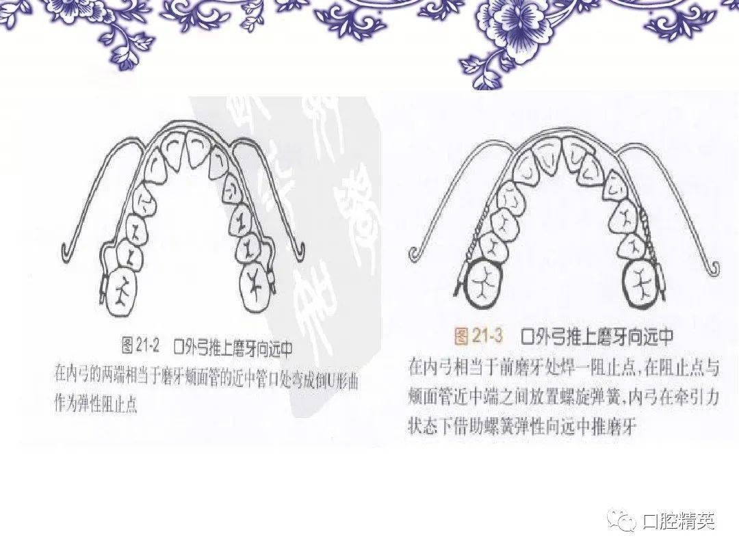 推磨牙向远中