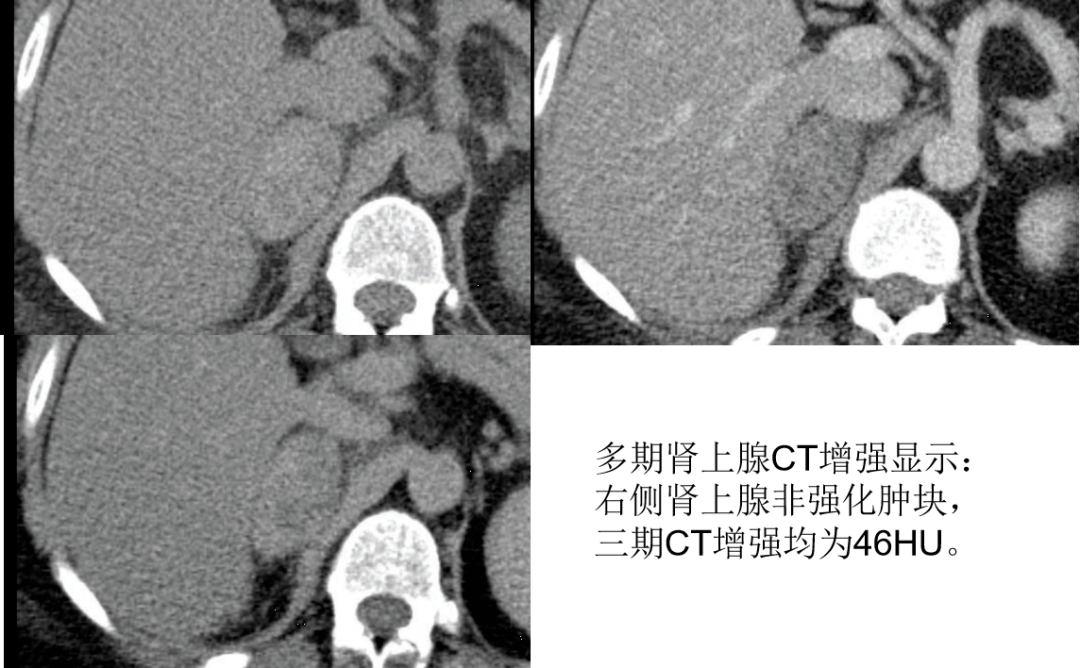 全面攻下肾上腺病变的影像学诊断