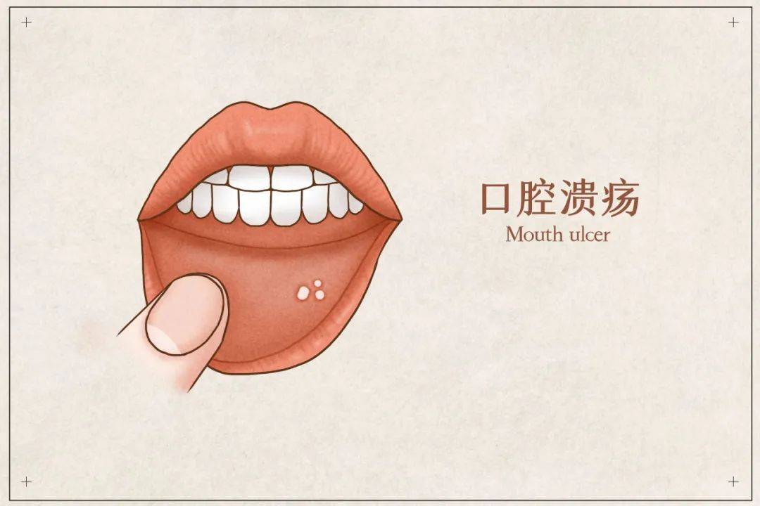 (1) 口腔黏膜出现白斑,红斑,黏膜下纤维性变 ,属于癌前病变.