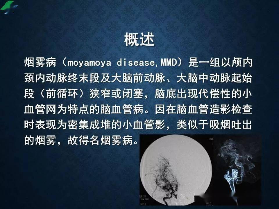 烟雾病的影像学诊断