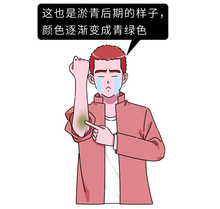 为啥女生膝盖总有淤青?真相不是你想的那样.