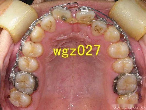 一例上颌中切牙严重扭转矫治经典过程组图