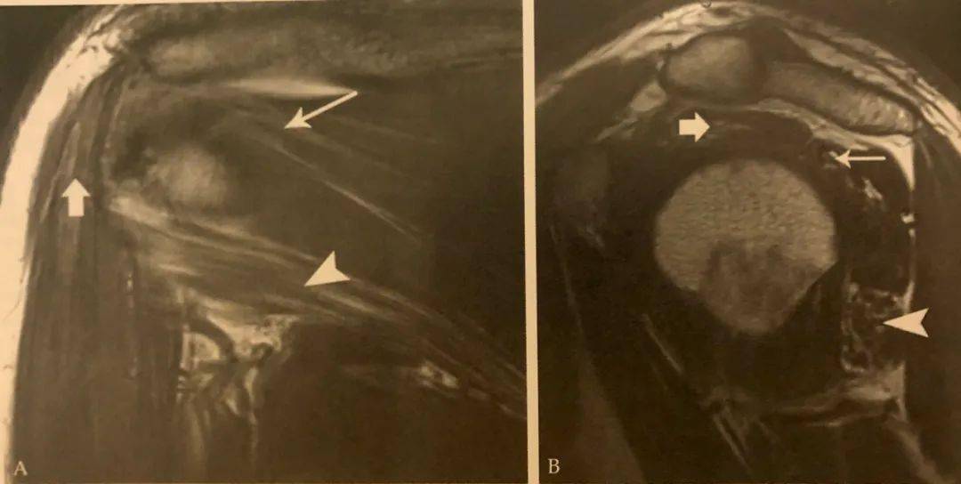 parsonage- turner 综合征: mri t1wi 冠状位图像(a)显示三角肌(粗箭