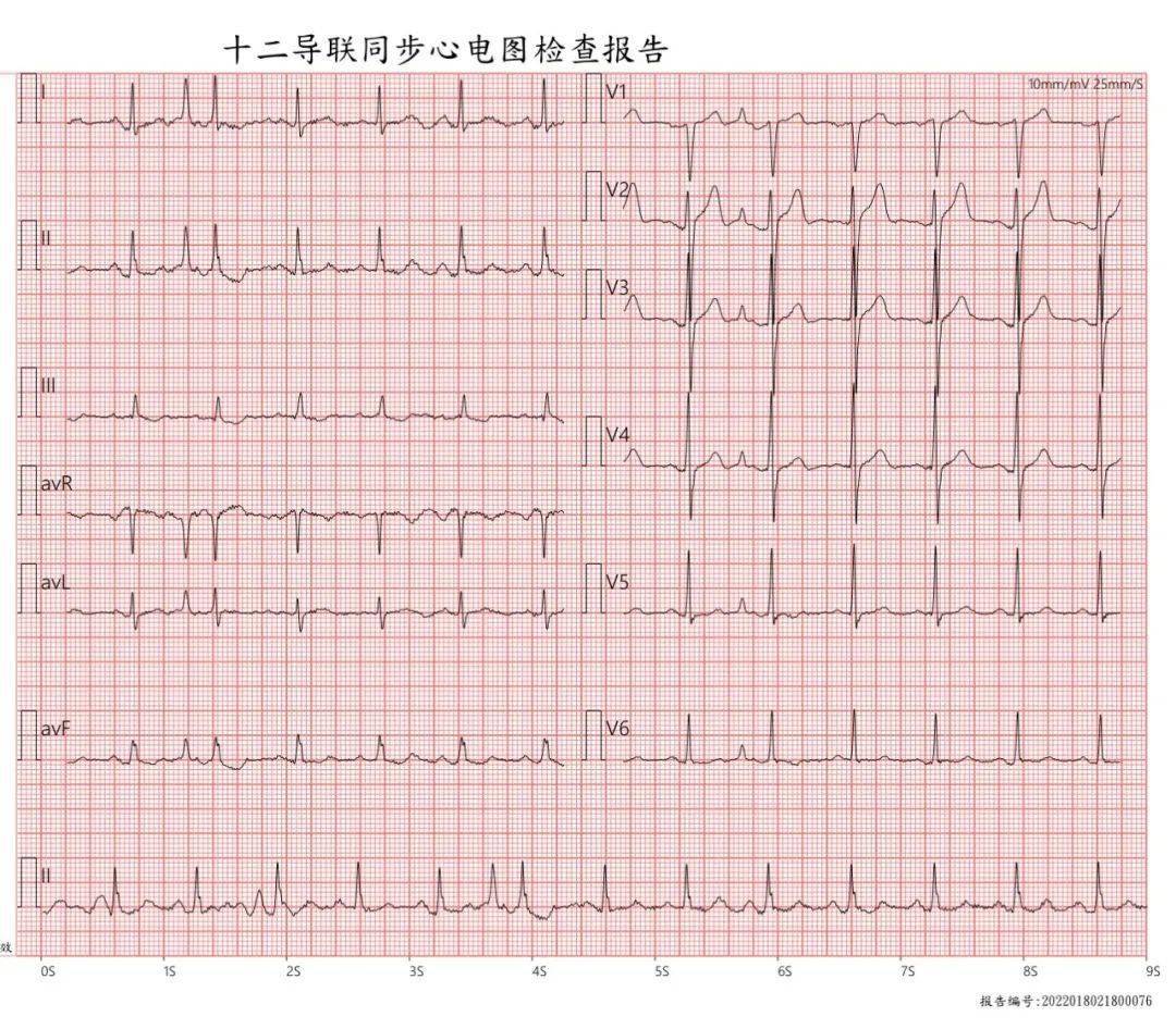 涨价倒计时 1 天 | 用【心电向量】零基础学习急性心梗心电图