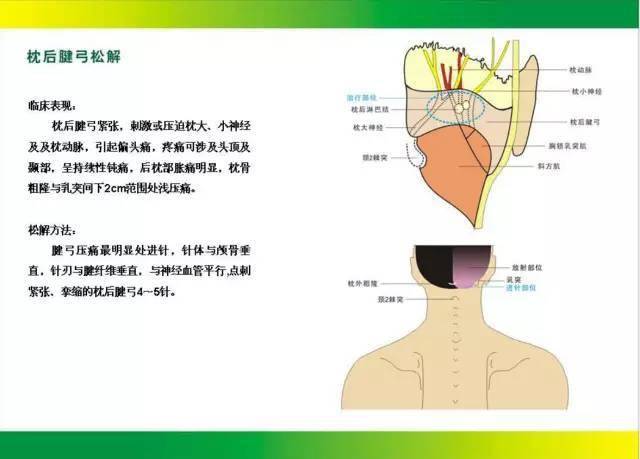 【干货】针刀松解治疗最全图解,赶紧收藏!_手机搜狐网