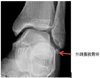 健康科普|脚踝扭伤了,应该怎么办?