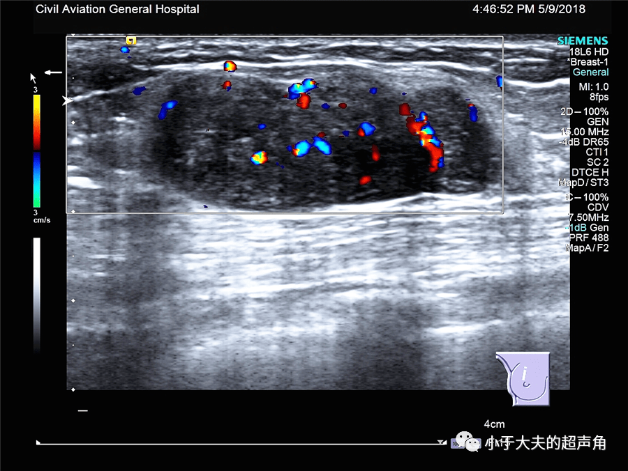 >>>新年好   【超声随响】第43期 乳腺叶状肿瘤 =2021