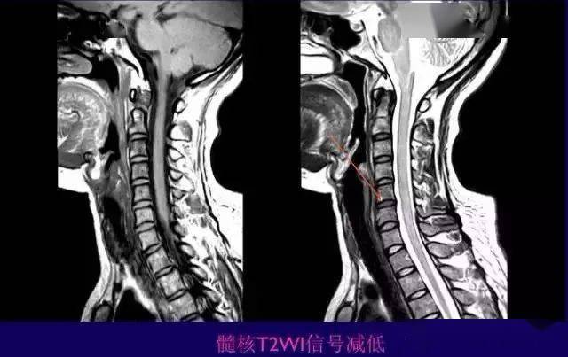 影像科医生不能诊断颈椎病,可以报告这6种诊断意见