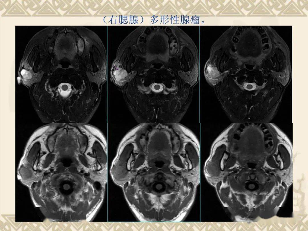 腮腺解剖及病变影像学表现