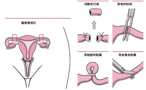 生完二胎老公让我去结扎