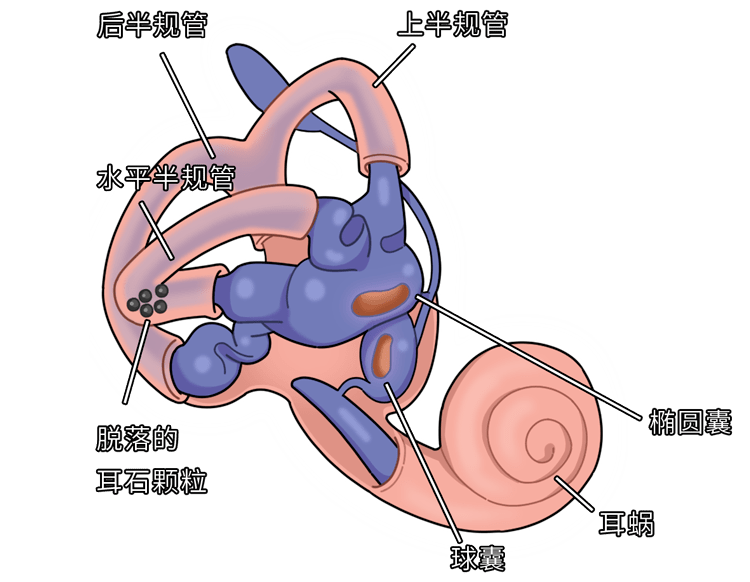 头部受外伤或患上一些疾病 都会增加耳石脱落的风险 一旦脱落 人就