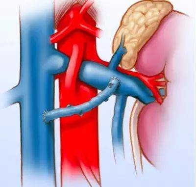 图「胡桃夹」综合症示意图肾静脉狭窄最有名的是「胡桃夹」综合征