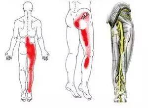 坐骨神经痛是因为坐骨神经受压或发炎而引起的疼痛症状.