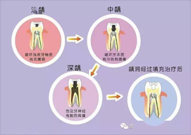 龋齿(虫牙)的前生今世