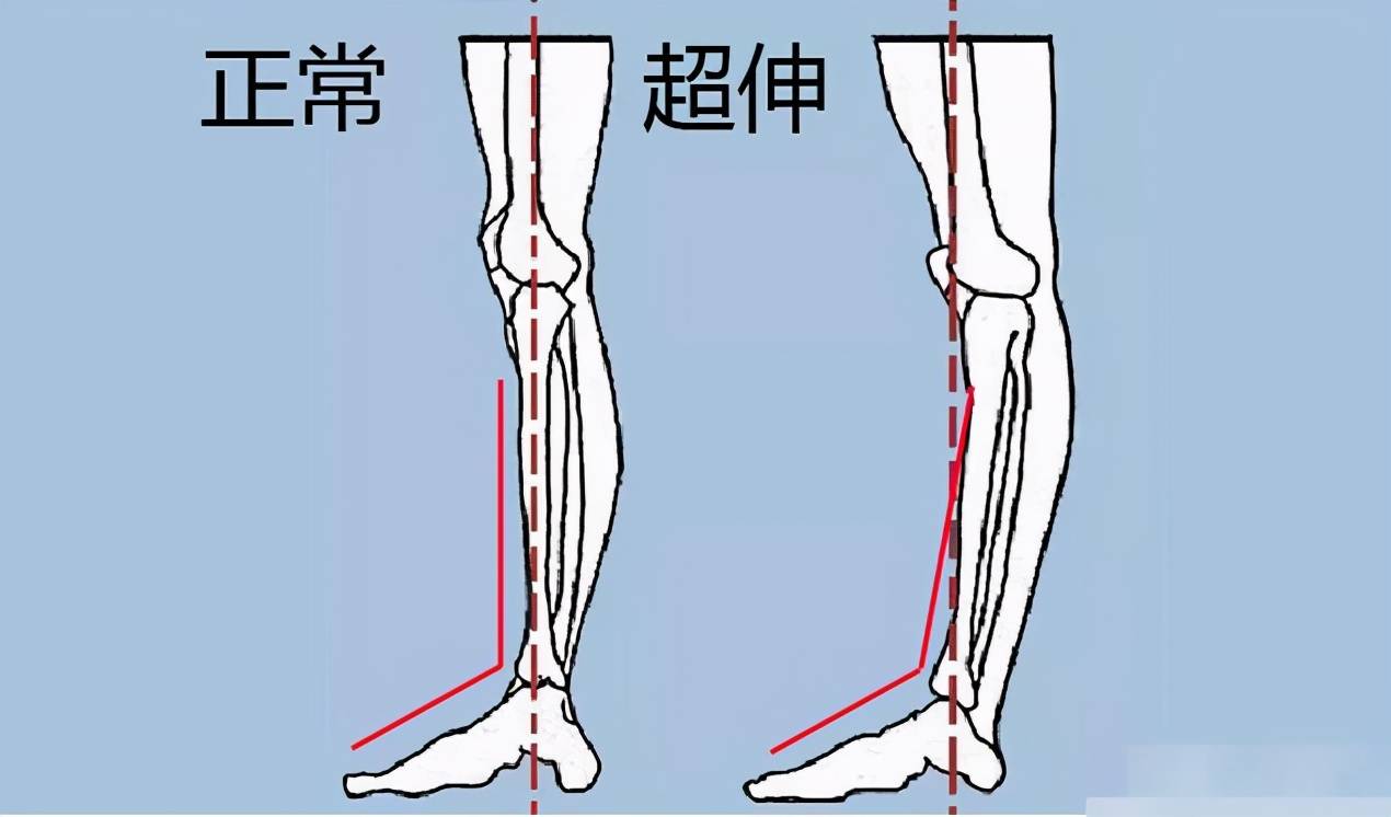 大腿往前突出,小腿往后突出,立正站直的时候从侧面看,膝关节往后,和