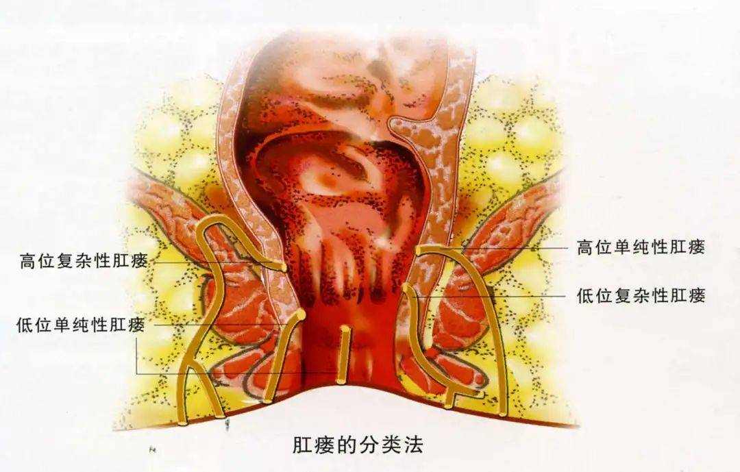 肛瘘如何分类又有哪些需要进行手术治疗