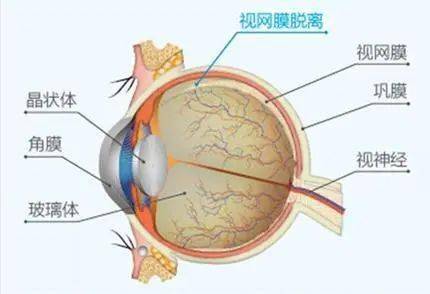 视网膜脱离,慈林医院眼科紧急手术保住患者视力!