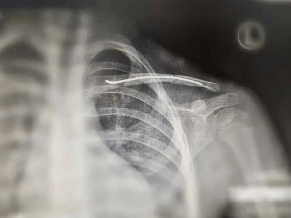5岁女孩左肩锁骨骨折,医生用了这个方法,手术后不留疤