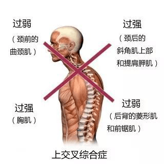 上交叉综合症是头部前倾,含胸,驼背,翼状肩或肩胛骨内侧下角耸起等一