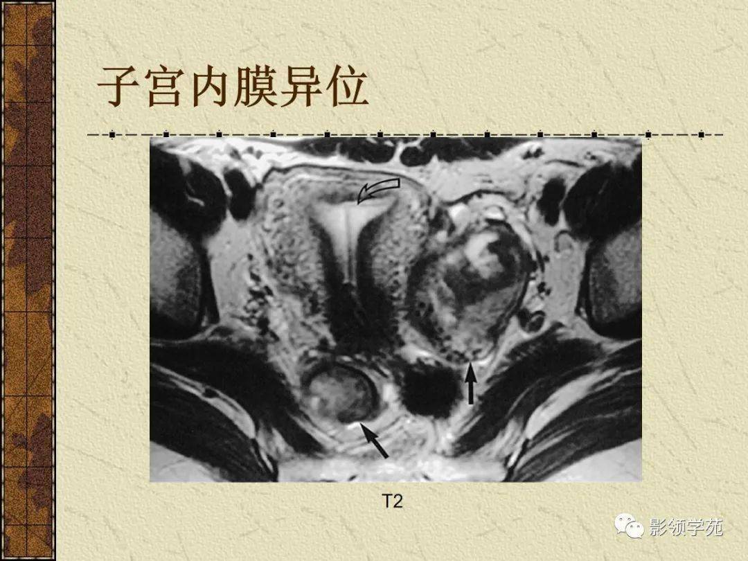 女性盆腔mri图谱t2wi-sag t1wi-sag(增强)t2wi-sag子宫解剖卵巢及附件