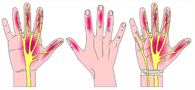 病情严重时,可能出现肌肉萎缩,  主要在大拇指这一侧,拇指会变得不