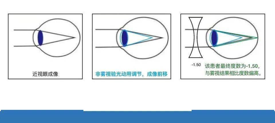 微课堂雾视验光的重要性