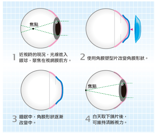 手术治疗近视是什么原理_近视激光手术原理图解