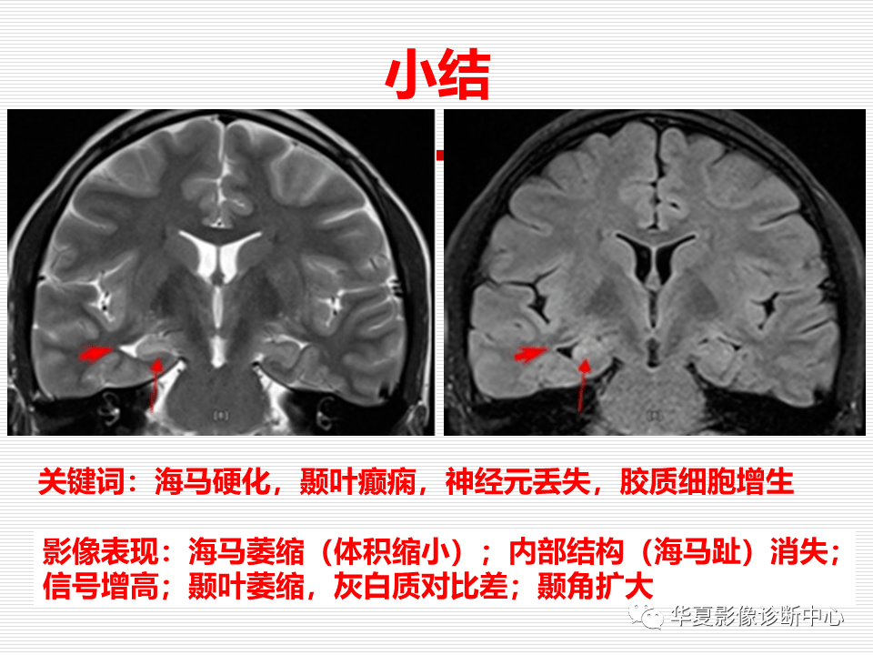 关于海马硬化的影像诊断