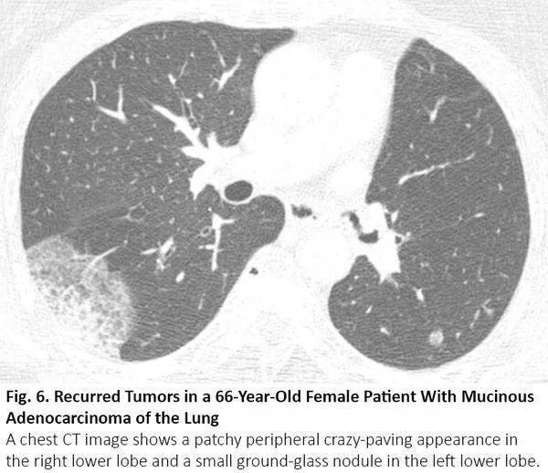 当肺癌患者感染covid-19,胸部ct如何鉴别?