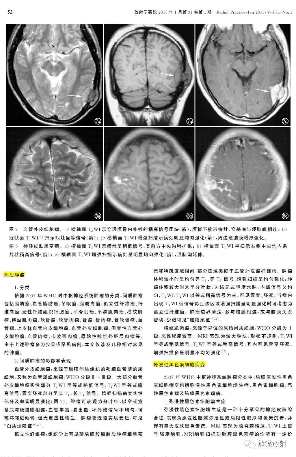 图文讲座丨硬脑膜占位病变的mri诊断_肿瘤