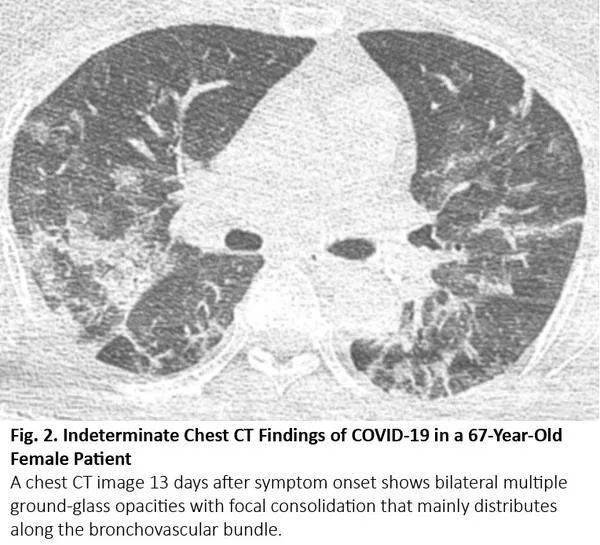 当肺癌患者感染covid-19,胸部ct如何鉴别?