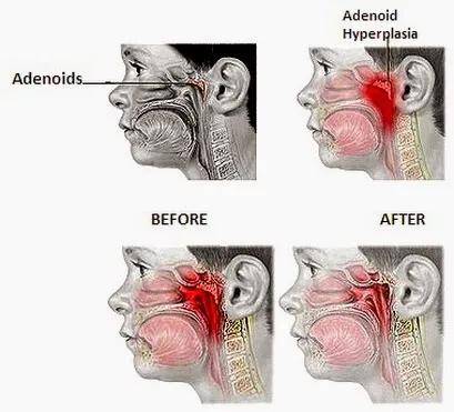 孩子烦躁,反复感冒,睡不踏实,可能是腺样体肥大!7岁前