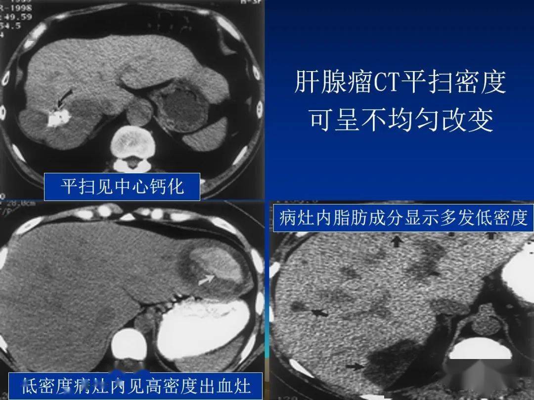 肝细胞腺瘤(ha)的影像学表现