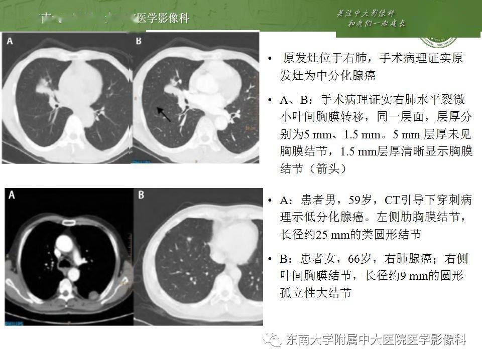 干性胸膜转移影像表现