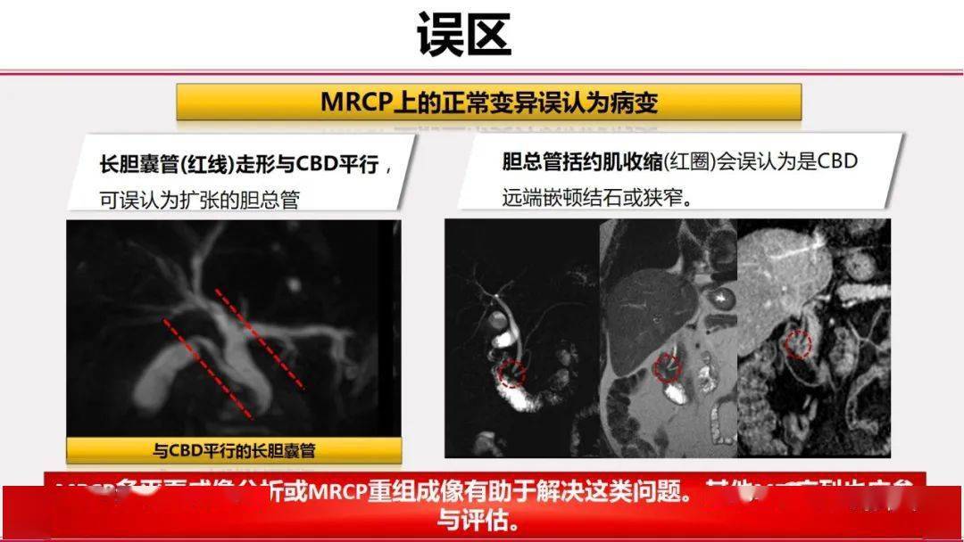 图文并茂放射科医生必知mrcp