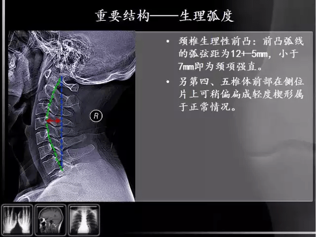 通俗易懂的脊椎x光片读片指南,值得收藏