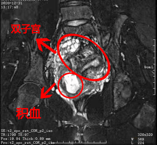 阴道斜隔综合征是一种比较罕见的的生殖道畸形,双子宫双宫颈,两个宫颈