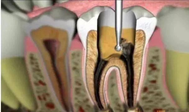 出了问题的牙神经会在牙齿内部腐坏,发酵,造成严重的感染和疼痛.