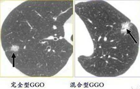 如何分辨肺结节的良恶性