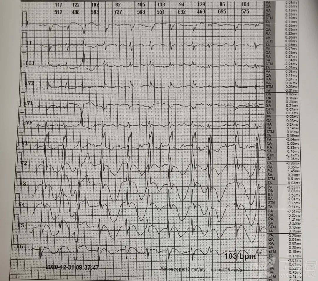 仅4 小时患者心脏骤停,这个心电图千万别忽略!| 达摩心电图专栏