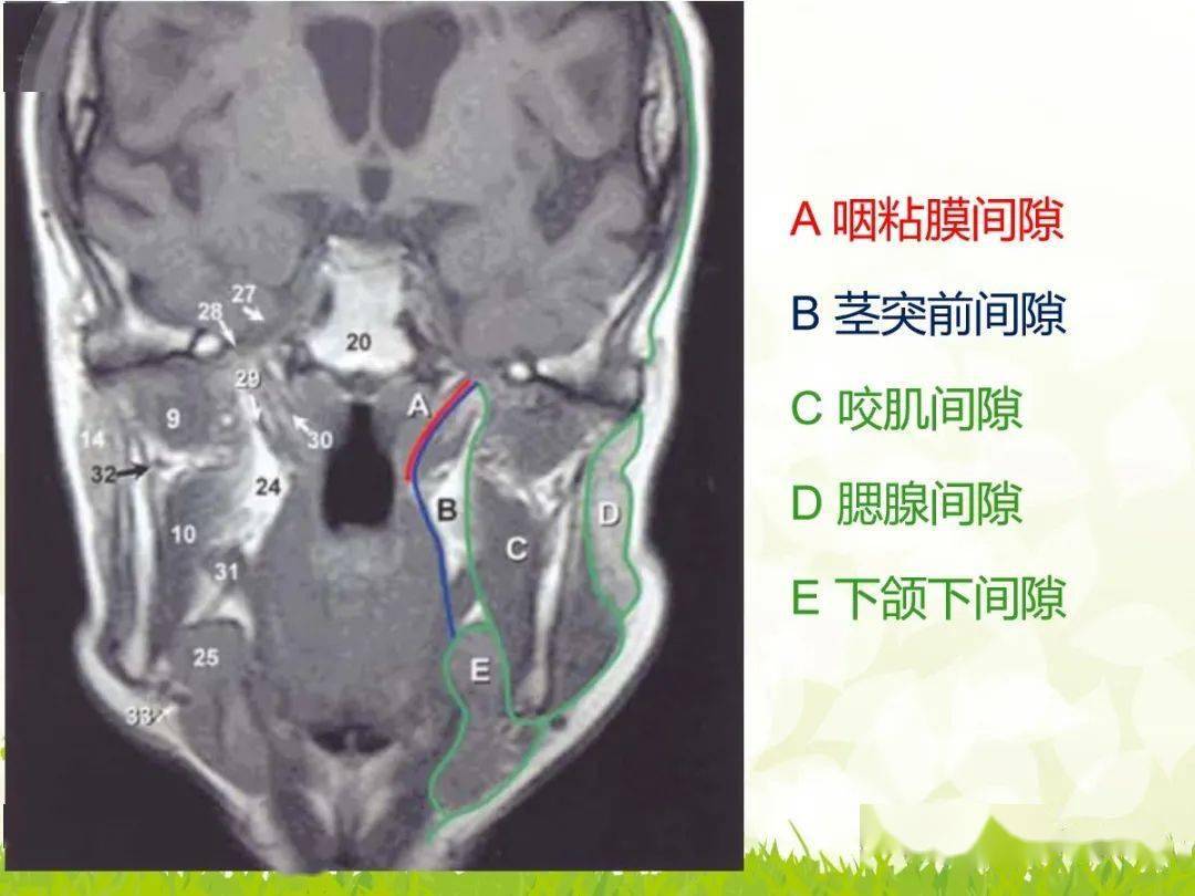 咽旁间隙解剖及常见病变影像表现