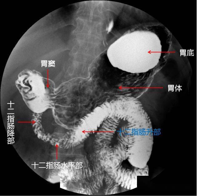 上消化道造影检查技术及常见病变的x线诊断