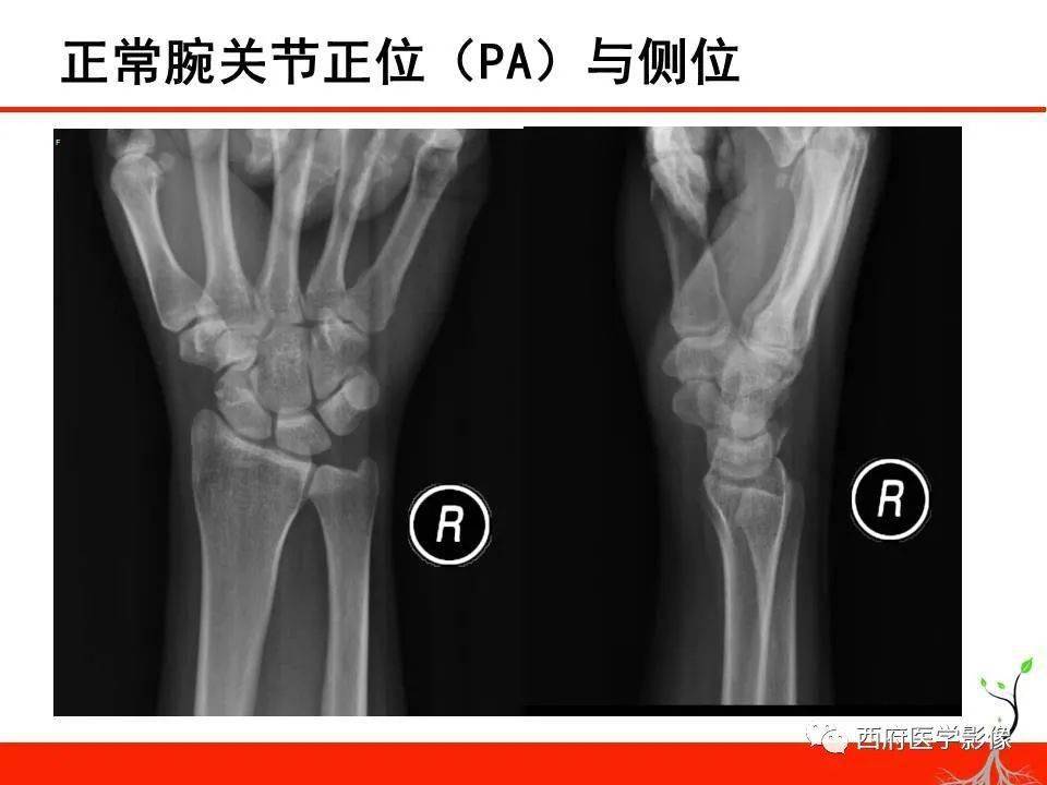 成人腕关节外伤x线诊断_手机搜狐网