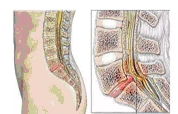 腰椎脊管狭窄的针刀治疗