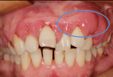 科普长廊牙龈增生与降压药有什么关系