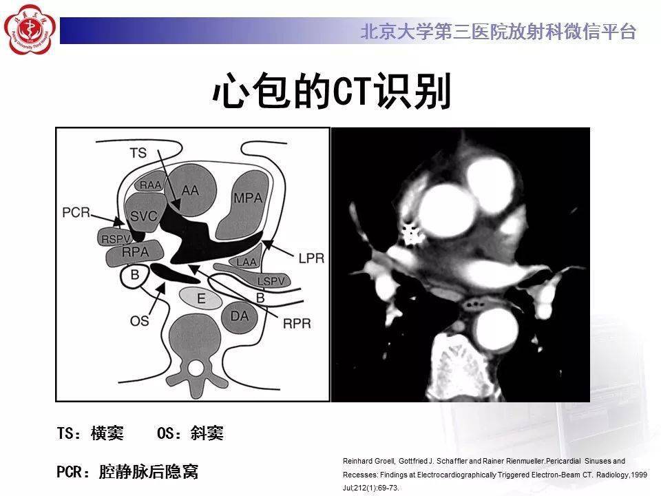 心包窦及心包隐窝解剖