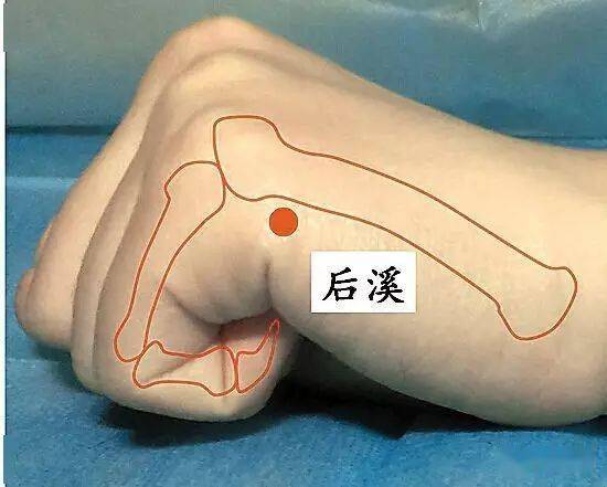 后溪穴:治疗颈椎腰椎病