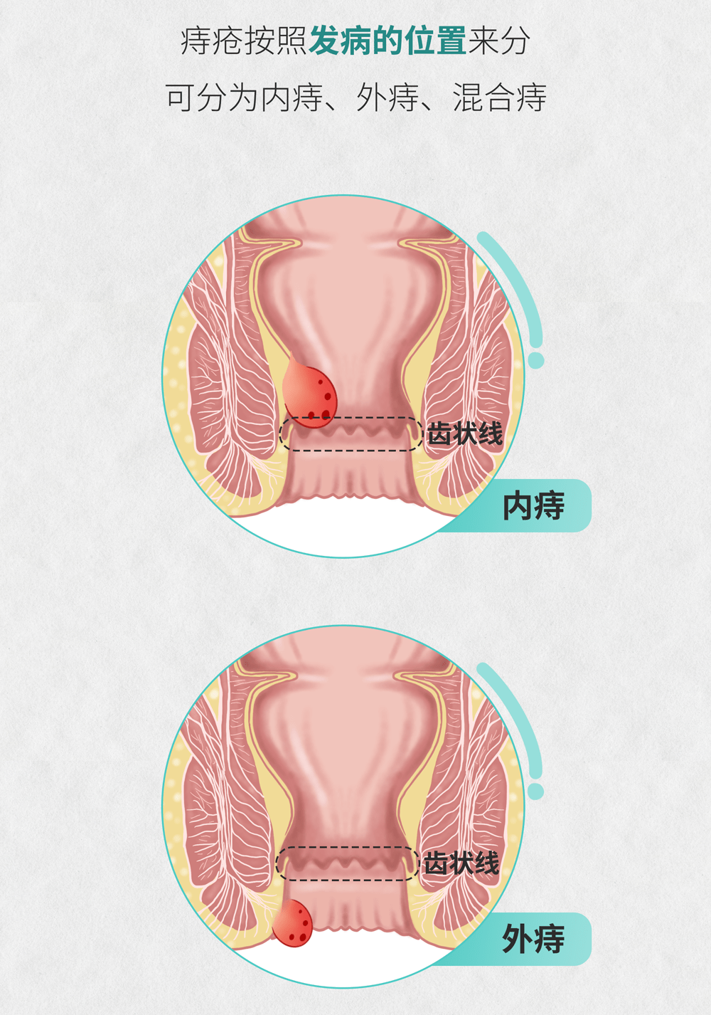 肠画短说:十男九痔,但你真的了解痔疮吗?