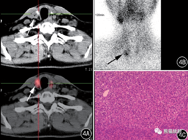 显像示右侧甲状旁腺区放射性核素异常浓聚,病理诊断为甲状旁腺腺瘤