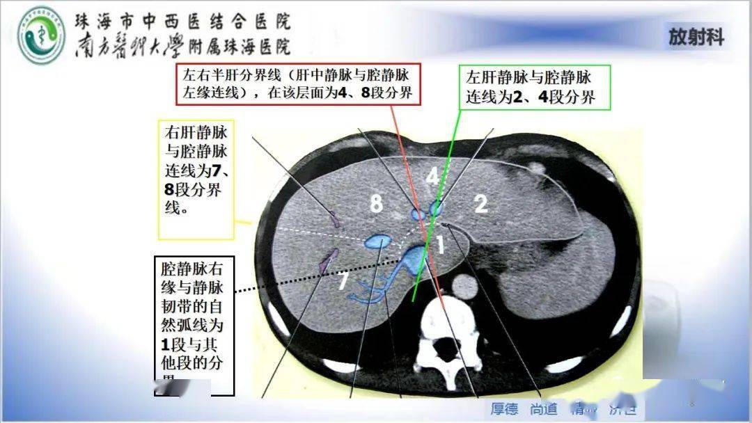 肝脏影像分段及肝硬化结节mri诊断